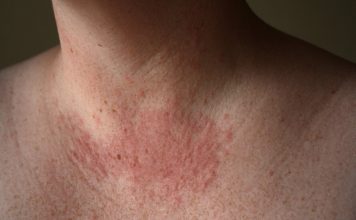 Cum sa combatem alergia la soare?