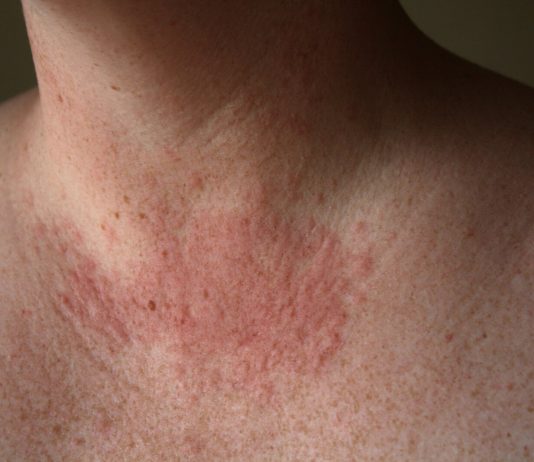Cum sa combatem alergia la soare?