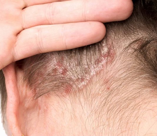 Psoriazisul scalpului: cauze, simptome si tratament