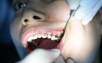 Semne care arată că ai putea avea nevoie de aparat dentar
