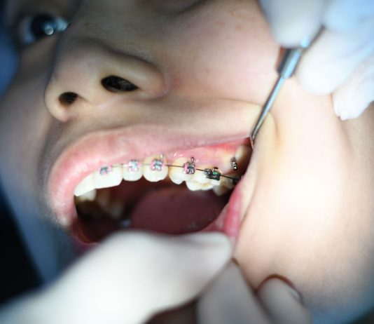 Semne care arată că ai putea avea nevoie de aparat dentar