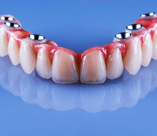 Beneficiile tratamentului cu implant dentar pe care sa le stii